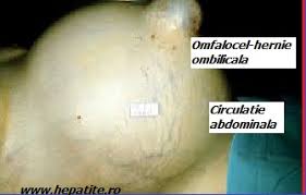 Solutia sclerozanta clasica este de clorhidrat dublu de chinina si uree 5% sau mai bine tolerat este. Care Sunt Simptomele Cirozei Hepatice Cabinet De Gastroenterologie Si Hepatologie Bucuresti 0758 751 841 Cabinet De Gastroenterologie Si Hepatologie Bucuresti 0758 751 841