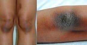 Vous Souffrez Des Genoux Et Coudes Fonces Ou Noirs Voici 2 Recettes Faites Maison Pour Les Blanchir Et Leur Rendre Leur Hum Dark Elbows Dark Armpits Skin Care