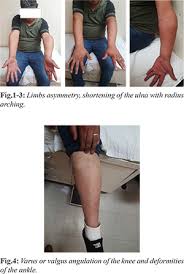 Maffucci S Syndrome A Rare Diagnosis