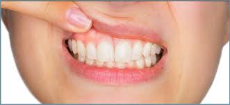 Calcium Therapy For Gum Disease Fortinsky Dentistry