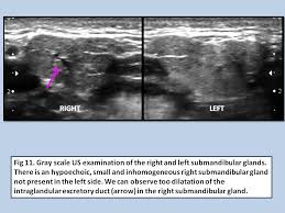 Image result for Submandibular Exam