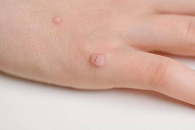 How To Prevent the Spread of Warts
