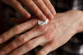 Image result for psoriasis
