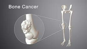 The cancer cells have the potential to weaken the bones and thus. Bone Cancer Types Symptoms Causes And Treatment Scientific Animations