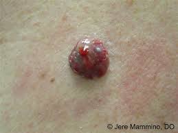 Changing mole or mole that looks different from your others. Melanoma American Osteopathic College Of Dermatology Aocd