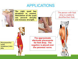 Neuromuscular Electrical Stimulation Nmes Ppt Video