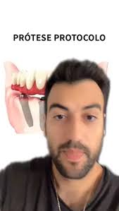 amil dental e80 & amil dental e80 cobre protese| D ...| Kwai