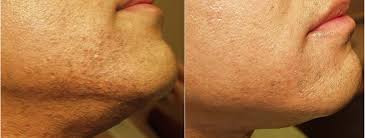 Facial hair on women is very common, completely natural, and can be triggered by certain medications or hormonal changes — and you shouldn't feel like you need to do anything about it. Facial Hair Removal Philadelphia For Women And Men Main Line Pa