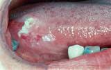 Image result for white cancer on tongue)