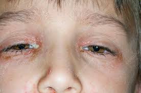 Image result for Bacterial Conjunctivitis