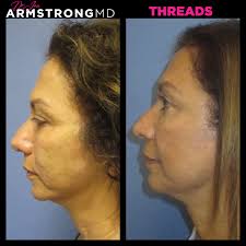 Say hello to the Armstrong MD Body Laser — the first of its kind! This  revolutionary treatment targets crepey skin, improves texture, tightens,  and evens skin tone — all in one. Ready