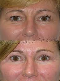 Before After Of A Eyelid Surgery Plasticsurgery Eyelid Surgery Surgery Plastic Surgery