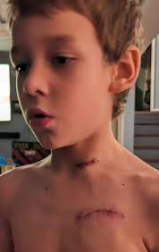 Goodbye Mr Vagus! Thank God!