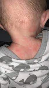 Babyhaut Rote Flecken Und Trocken Forum Baby Urbia De