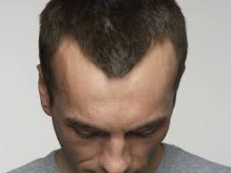 We did not find results for: If You Have A Receding Hairline Does It Stop Receding Or Does It Continue To Recede Until You Re Completely Bald Quora