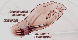 как избавиться от волос в зоне бикини народными средствами Bol V Sustavah Prohodit Uzhe Cherez 3 Dnya Chtoby Vosstanovit Sustavnyj Hryash Neobhodimo Zdorove Uprazhneniya Pohudenie