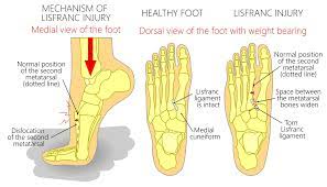 25 overall pick in april, was brought onto the roster to add speed. Lisfranc Injury Sussex Foot Ankle Clinic
