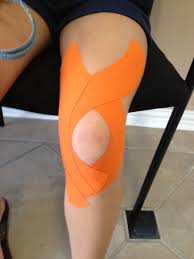 Patellar Tracking Support Kinesiology Taping Kinesio Taping Physio Tape