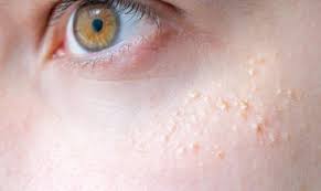 bebeklerin yuzundeki sivilce gibi kizariklik nasil gecer bebeklerin yuzunde cikan sivilceler neden olur bebek haberleri