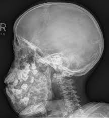 A cherub, or known in the plural form as cherubim, is a symbolical angelic figure repeatedly mentioned in the bible.cherubim are described as serving the will of god, performing divine duties in the earthly realm. Cherubism Radiology Case Radiopaedia Org