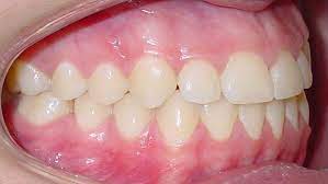 Ideale Verzahnung Kieferorthopade Lippstadt Dr Bianca Mertens