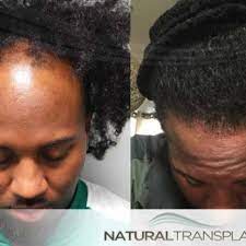 What Causes A Receding Hairline Hair Transplant Results Hair Transplant Male Pattern Baldness