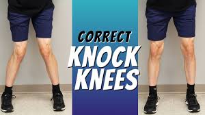 How to fix knock knees or genu valgum? Top 5 Ways To Correct Knock Knees With Exercise Etc Youtube