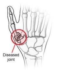 Informieren sie sich auf dieser seite, profitieren sie von anderen. Arthritis Of The Thumb Orthoinfo Aaos