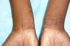 Image result for scabies human children