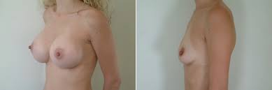 عمليات تكبير الصدر - الدكتور جوبرين