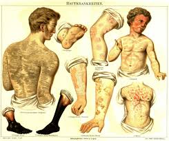 Image result for Ichthyosis