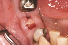 Image result for Alveolitis sicca)