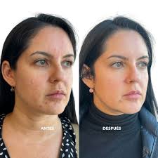 Fixer DV9 (3 sesiones) - Dra. Sierralta