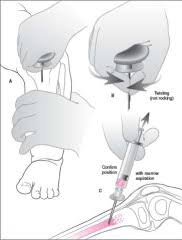 Image result for Intraosseous Access