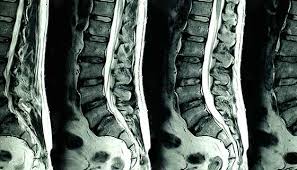 The strength of the magnetic field causes the atoms of the body to respond, and the emissions are detected by the scanner, which are analyzed, and an image is produced. Computed Tomography Ct Or Cat Scan Of The Brain Johns Hopkins Medicine