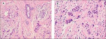 Inflammatory breast cancer (ibc) is a rare, aggressive form of breast cancer. Inflammatory Breast Cancer Unique Biological And Therapeutic Considerations Sciencedirect