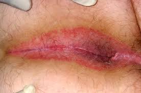 Image result for itchy skin rectum