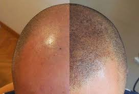 Souvent d'origine héréditaire, elle peut être ralentie grâce à des traitements adaptés. Le Top 3 Des Solutions Anti Perte De Cheveux Gentleman Moderne