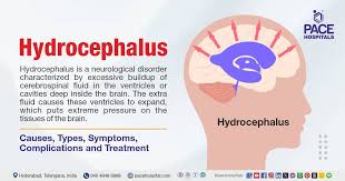Image result for Hydrocephalus