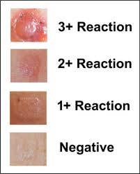 Image result for Patch Testing