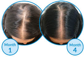 If you're truly struggling with depression or anxiety due to your hair loss, this will help you rewire your brain and eliminate your destructive behavioral patterns. Fear Of Stigma May Lead To Depression Related Hair Loss