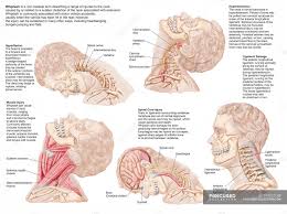 Medical Chart With The Range Of Injuries To The Human Neck