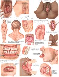 Image result for Cardiovascular Syphilis