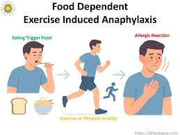 Image result for Exercise-Induced Anaphylaxis