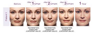 I only have one, it's visible and i look too serious, it's not deep though. Juvederm Ultra Xc Ultra Plus Xc Dermal Filler Aesthetica Skin Health Center