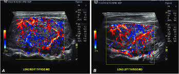 In the latter, the thyroid glands usually have normal or decreased vascularity and contain numerous tiny hypoechoic nodules. Doppler Ultrasonography Longitudinal Views Of The Right Lobe A And Download Scientific Diagram