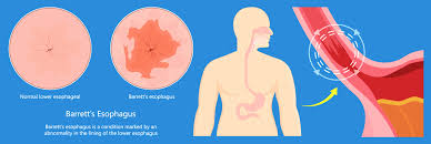 Image result for esophagus