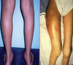 Muscle Bleeds Or Soft Tissue Bleeding And Hemophilia