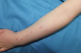 Image result for Papular urticaria