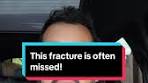 Commonly Missed Scaphoid Fracture: Symptoms, Treatment ...